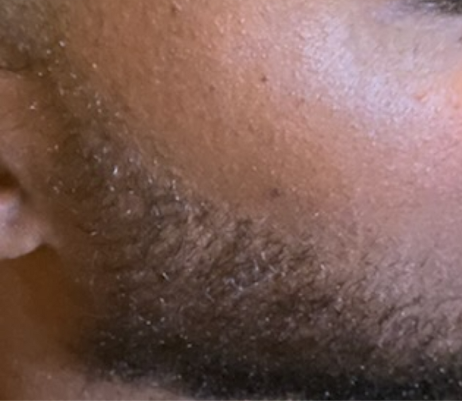 Skin after using ACEBLUR
